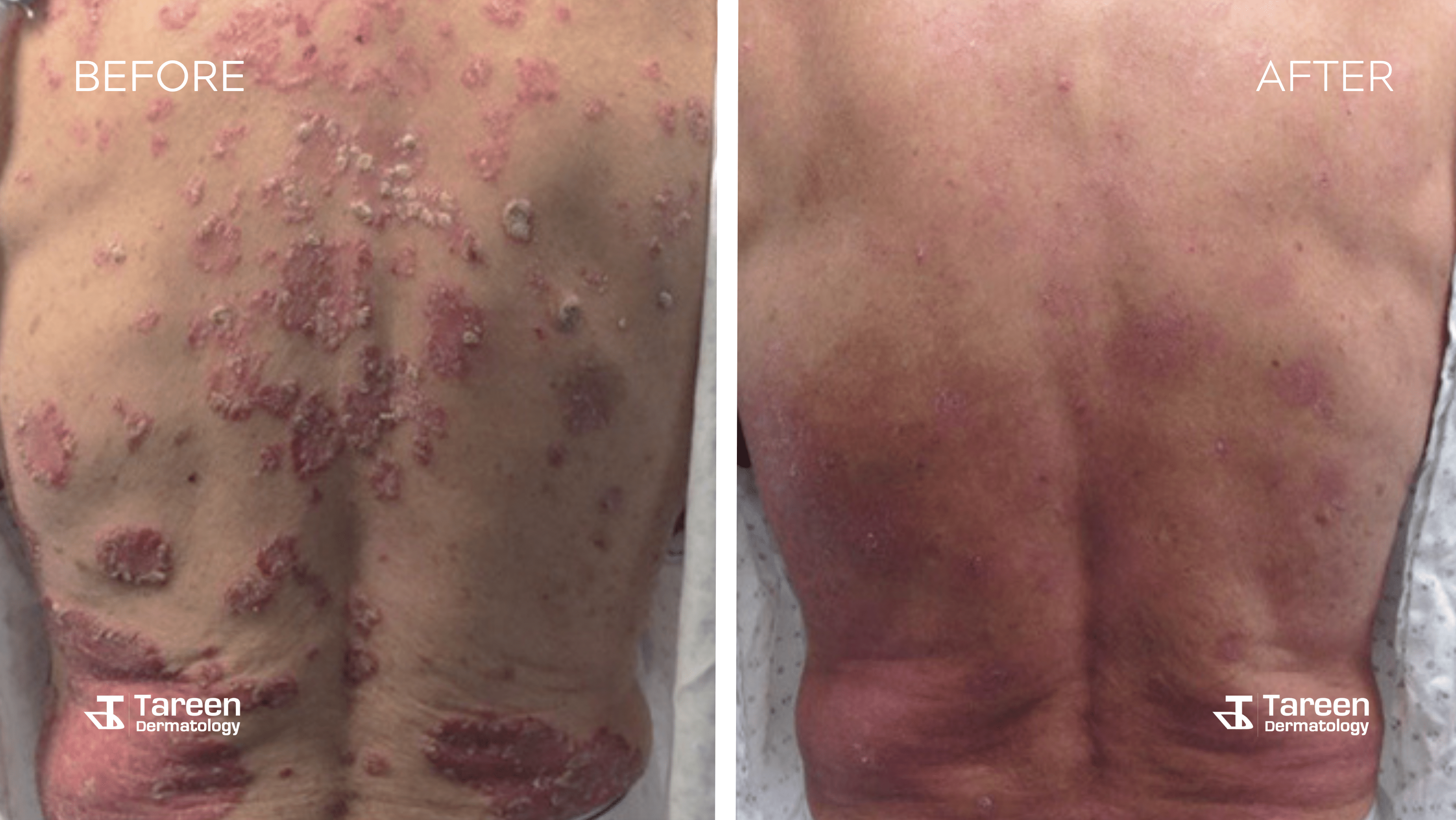 Before and After or Psoriasis