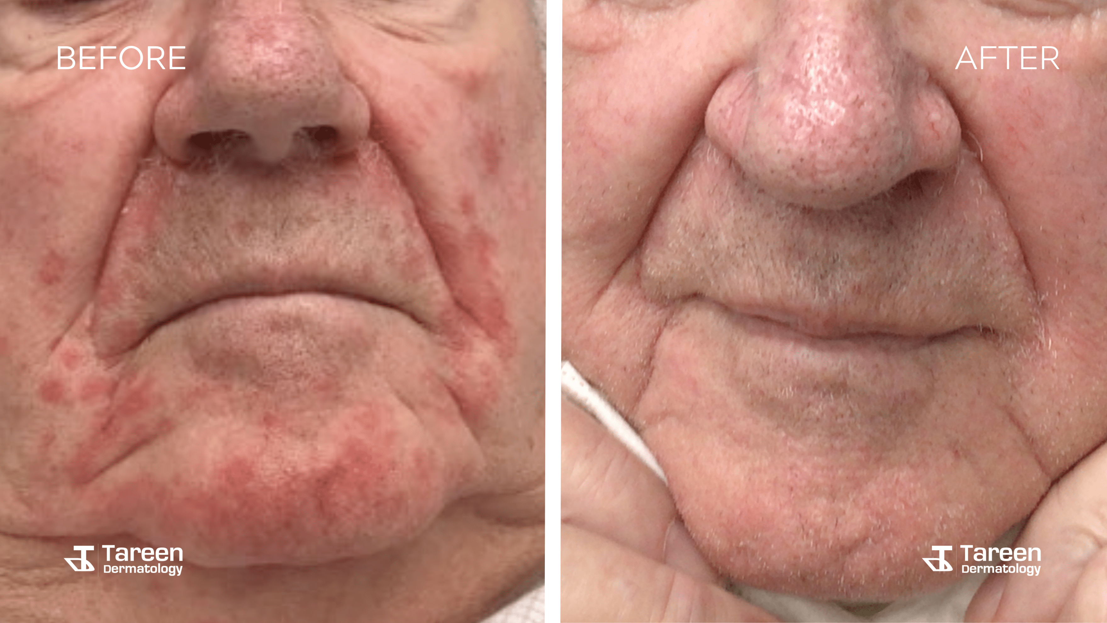 Before and After Seb Derm and Perioral Dermatitis