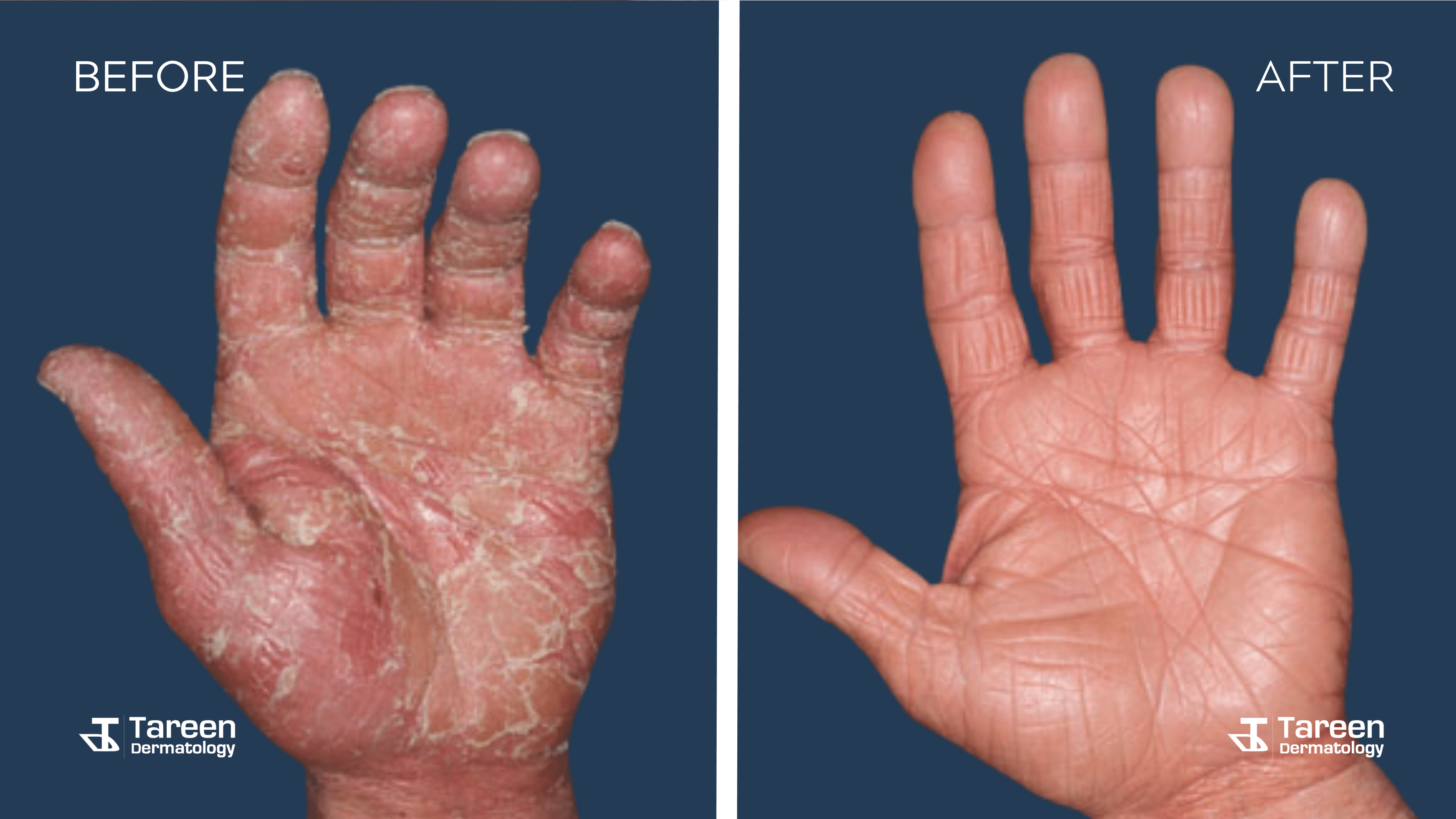 Before After Hand Eczema