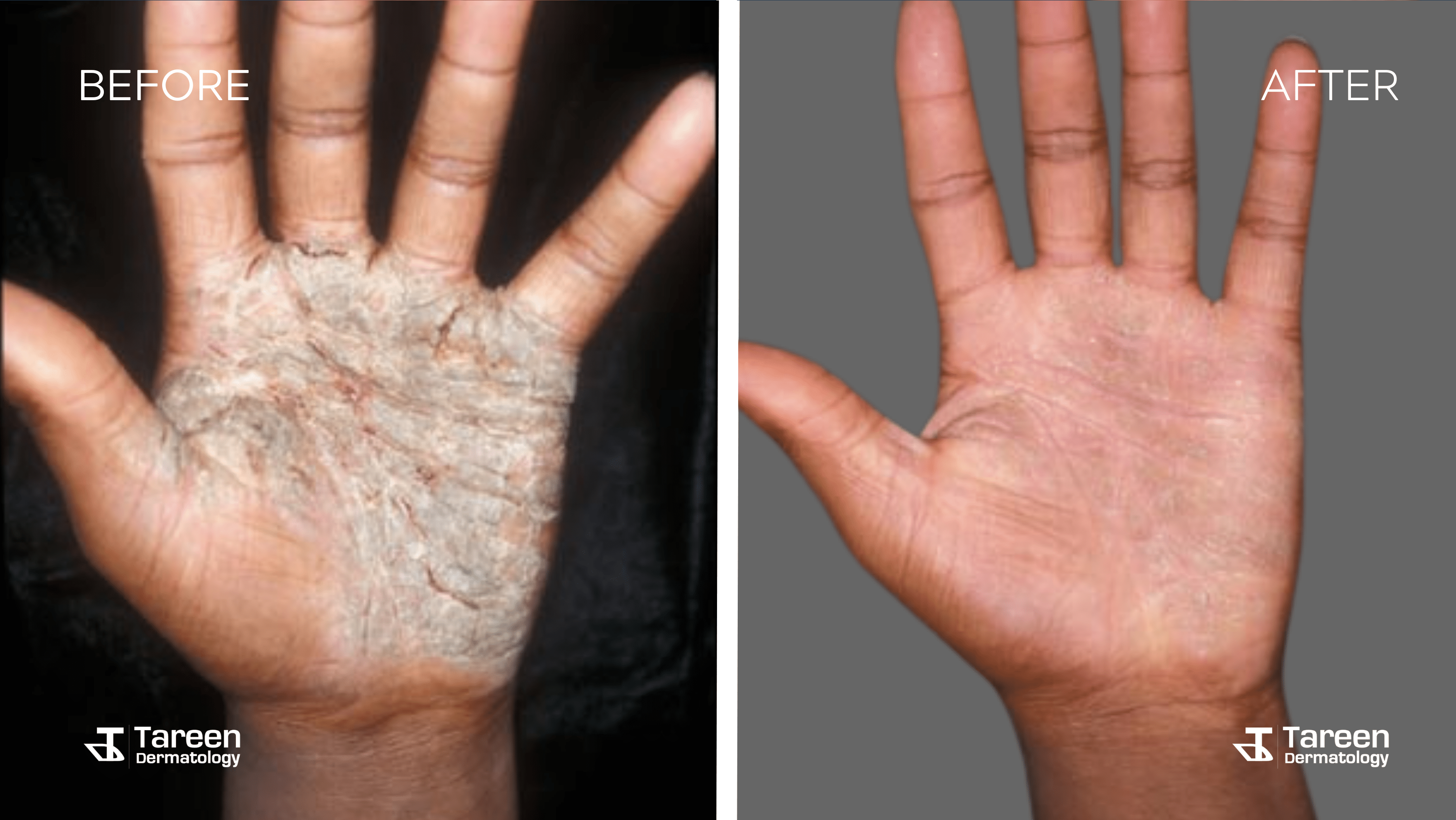 Before After Hand Eczema