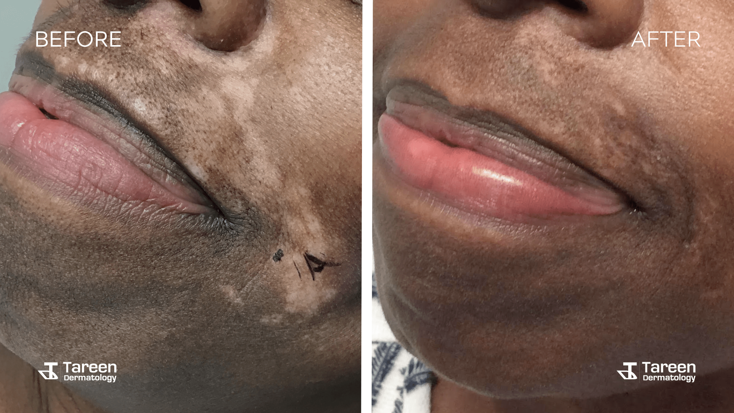 Vitiligo Before and After