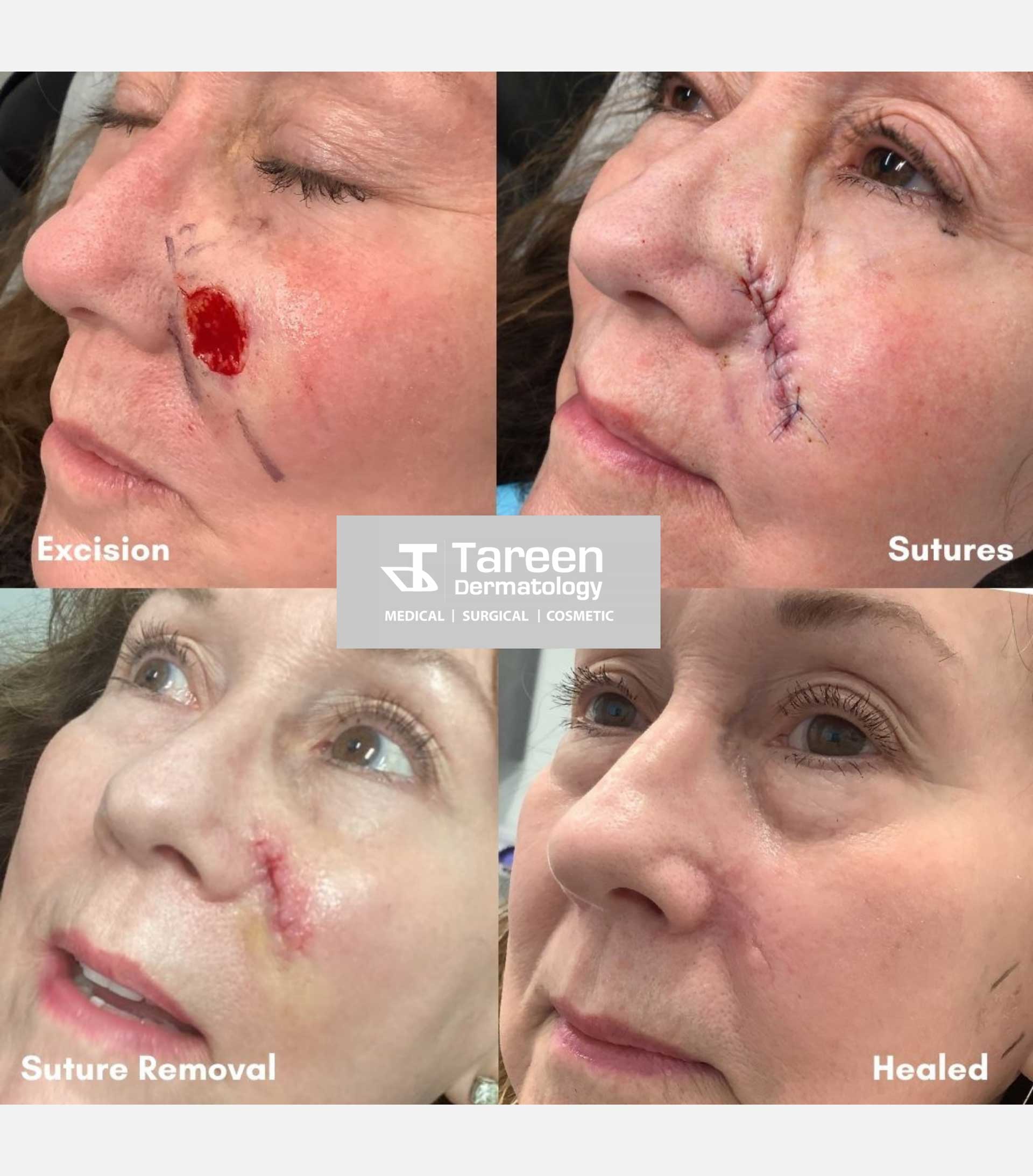 Basal Cell Mohs Surgery