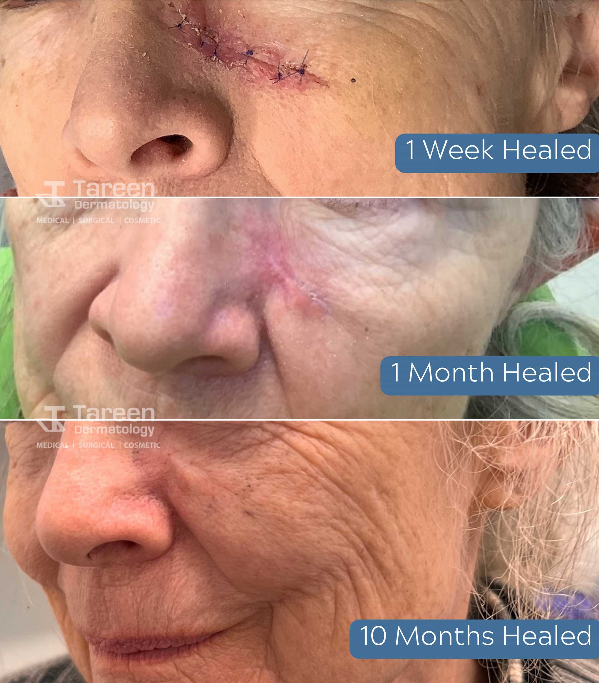 Skin Cancer Removal Healing Process