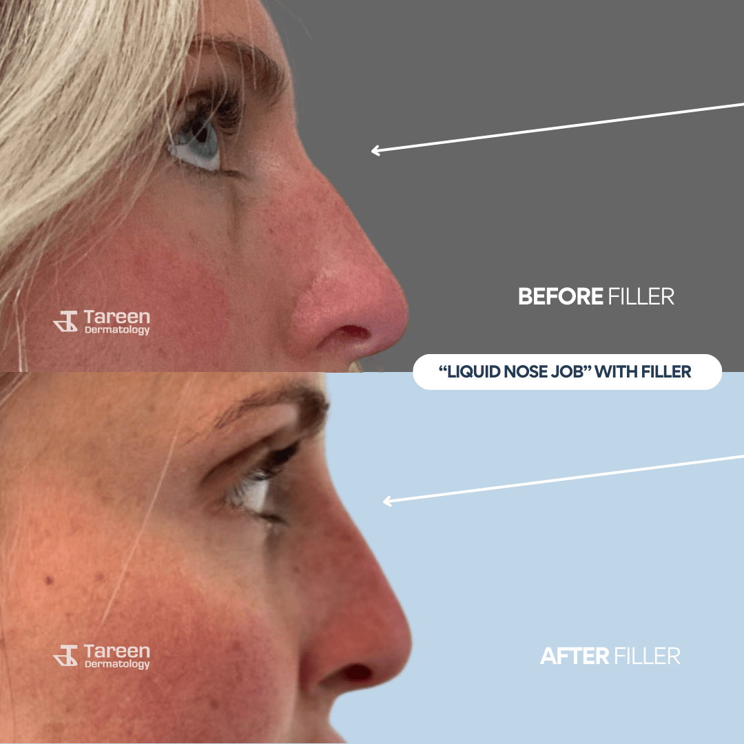 Dermal Fillers Tareen Dermatology