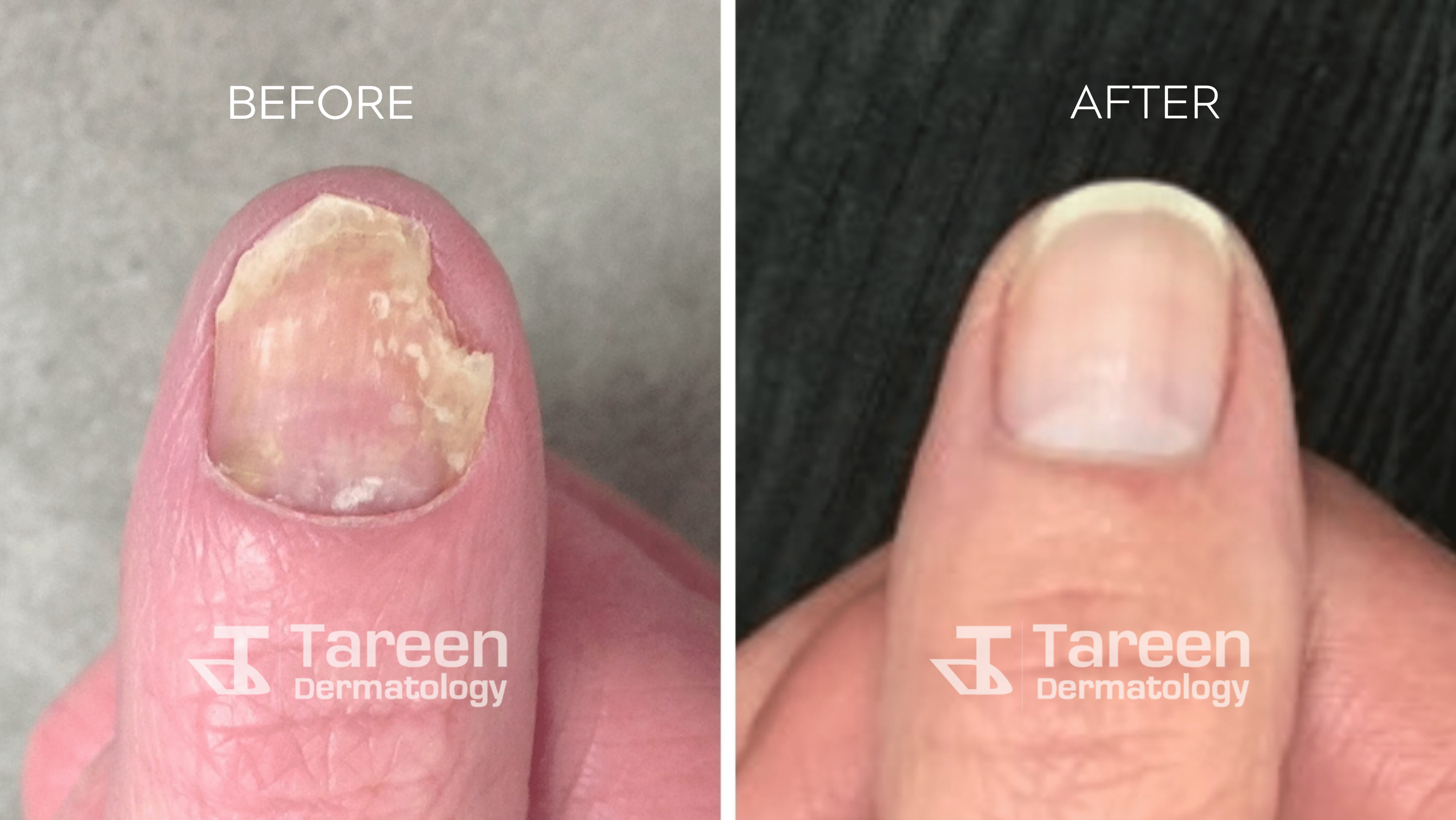 Finger Nail Fungus Treatment