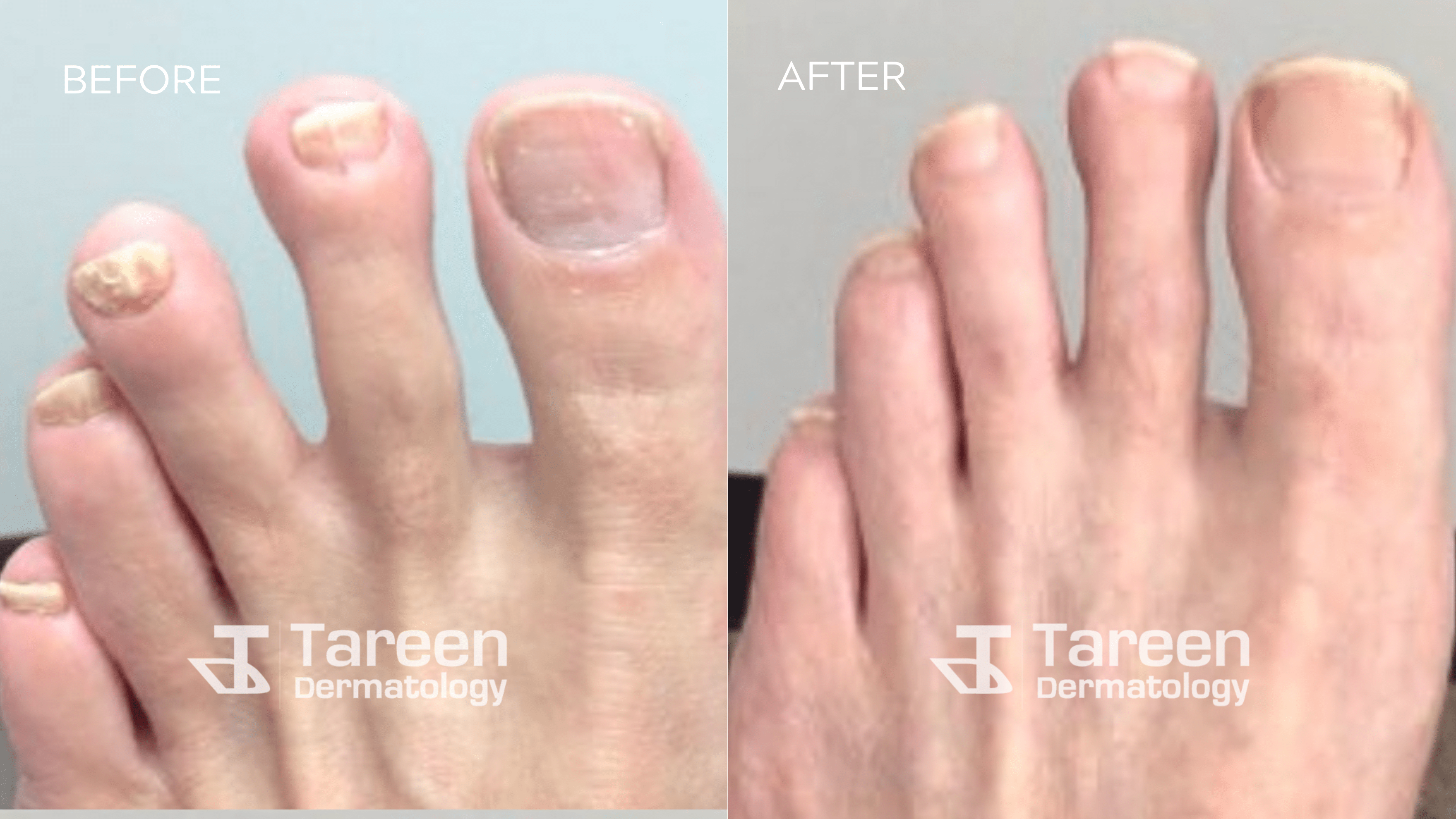 Toe Nail Fungus Treatment