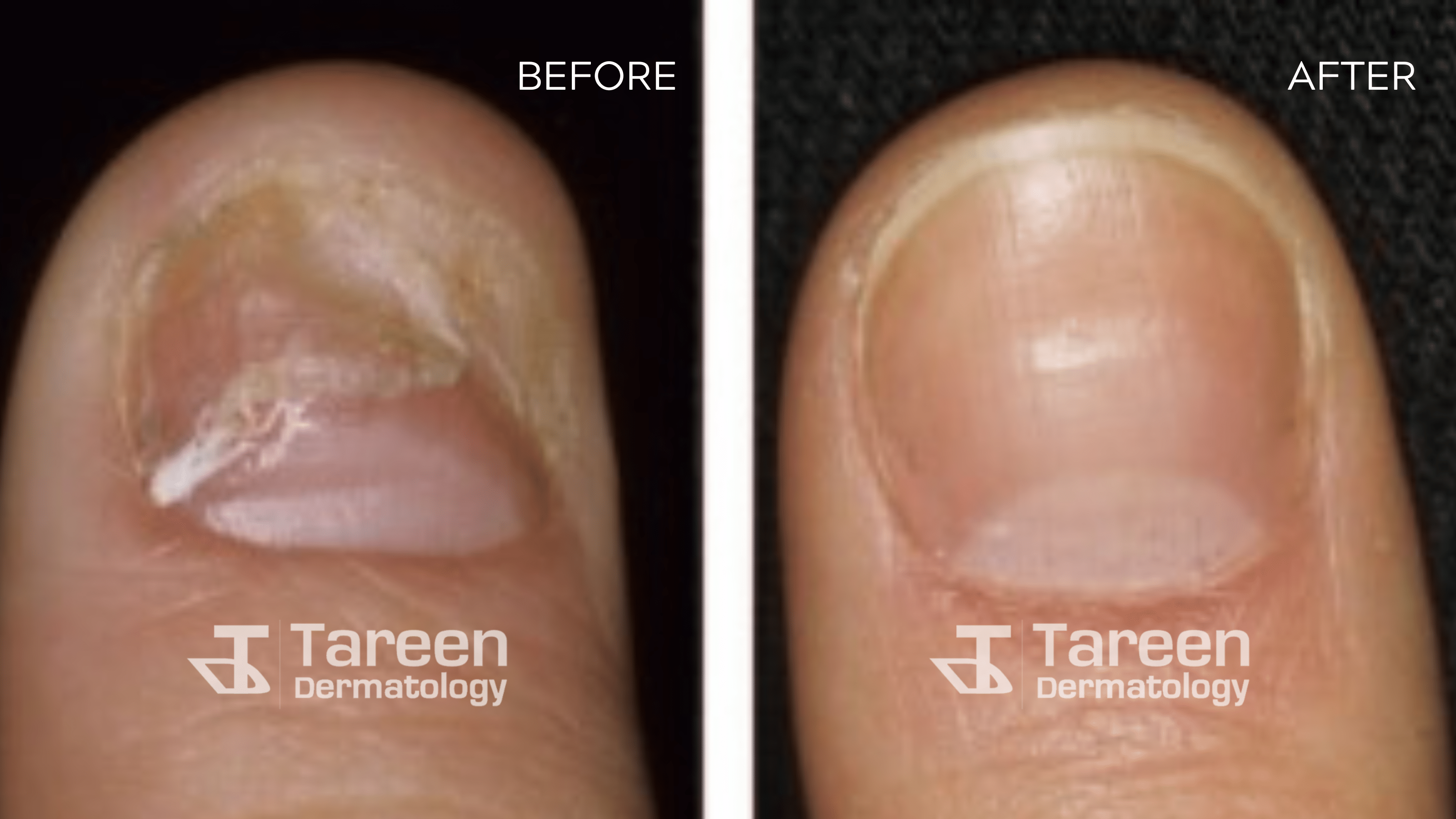 Finger Nail Fungus Treatment
