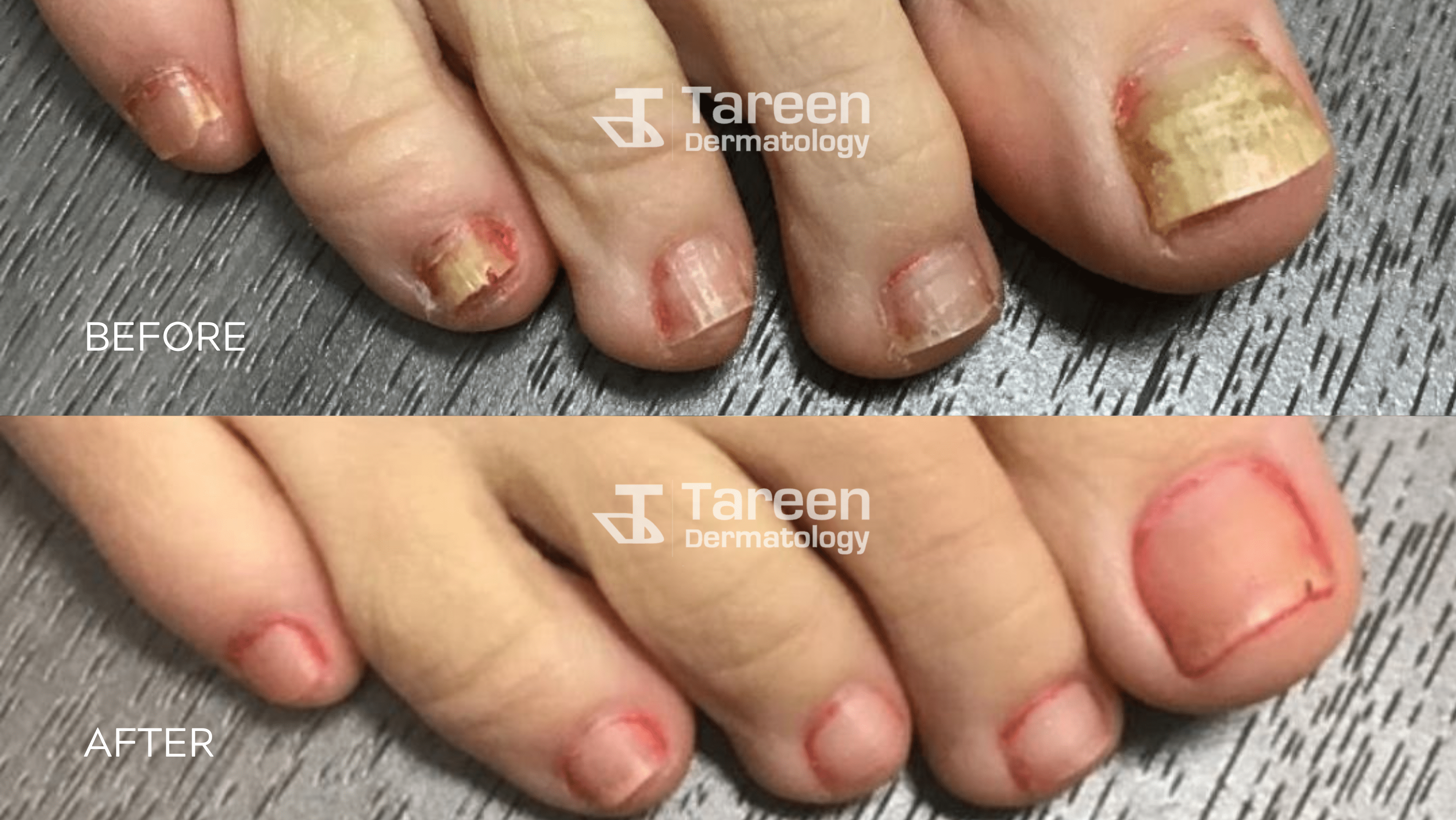 Toe Nail Fungus Treatment