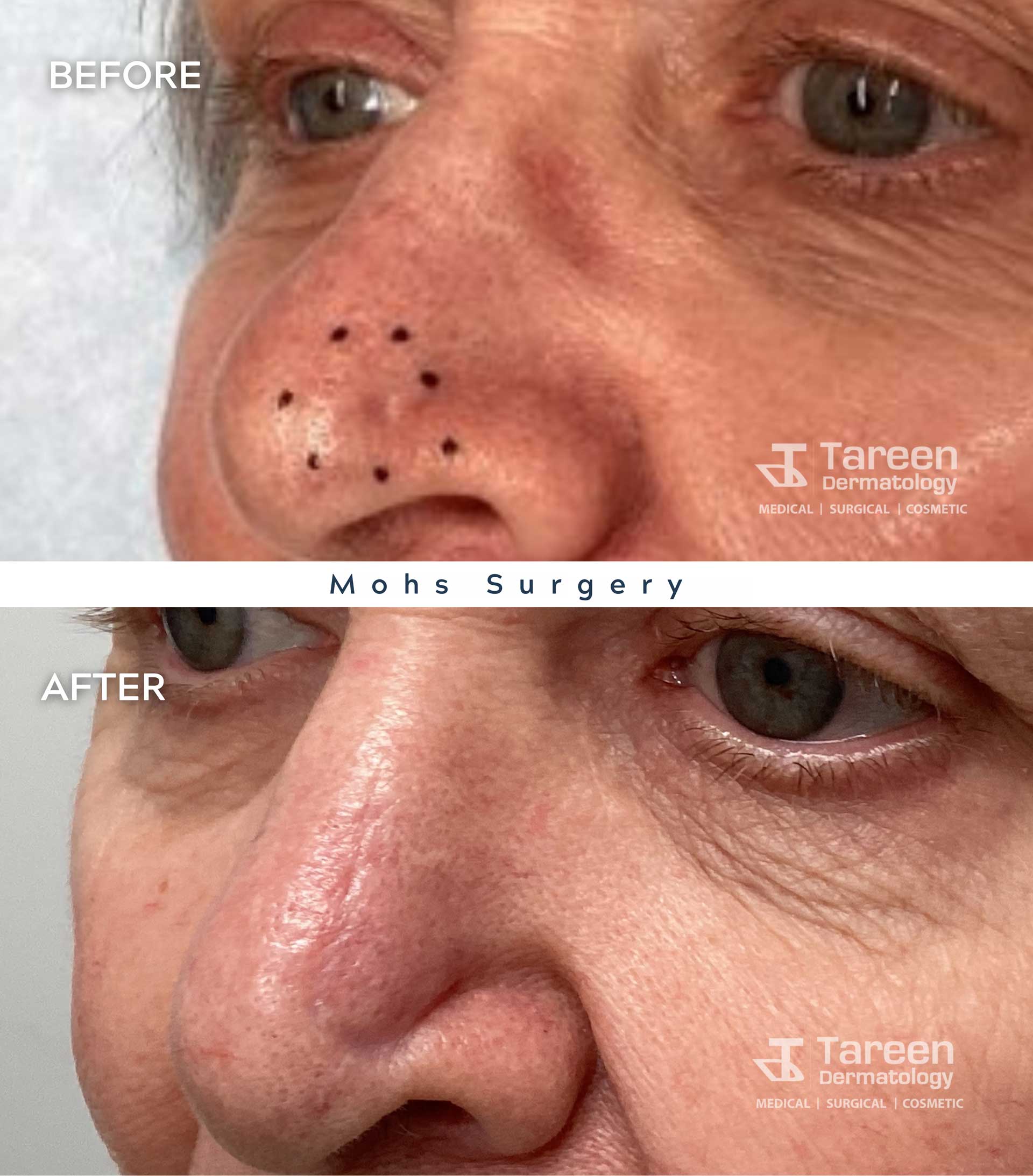 Mohs Surgery Results