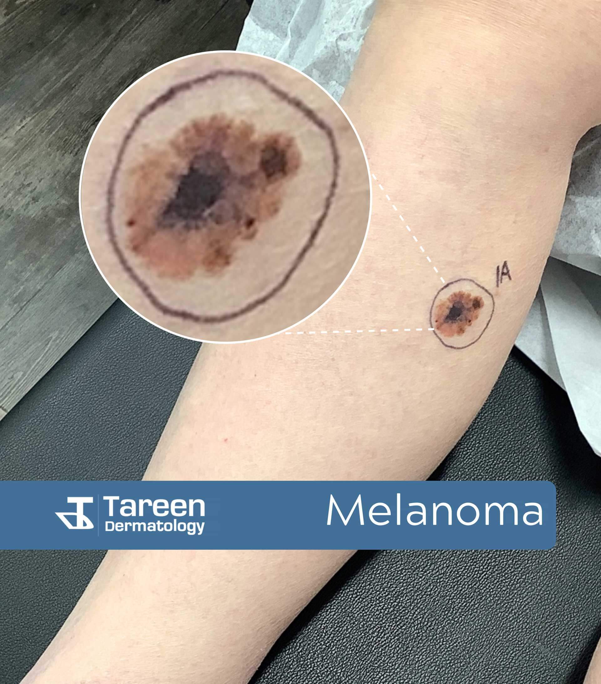 Melanoma Spot