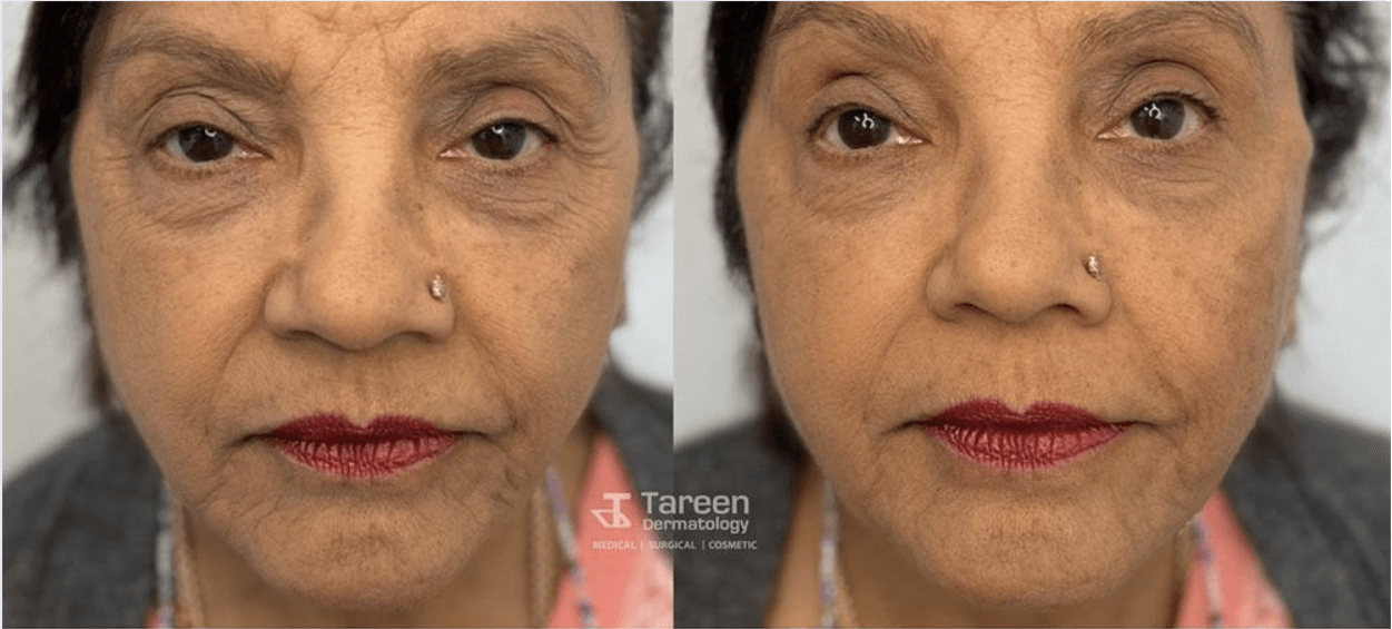 PDO Thread Lifts Minneapolis, MN Tareen Dermatology Tareen