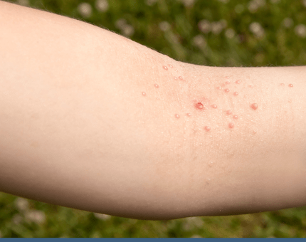 Guide to molluscum contagiosum treatment options including cryotherapy, topical creams, and dermatologist care.